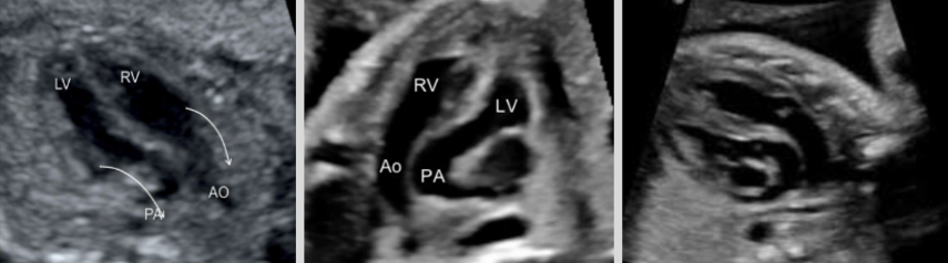 <ul><li><p><span style="background-color: transparent;">PA and Ao are swapped</span></p><ul><li><p><span style="background-color: transparent;">PA exits from left ventricle&nbsp;</span></p></li><li><p><span style="background-color: transparent;">Ao exist from right ventricle</span></p></li></ul></li><li><p><span style="background-color: transparent;">Associations: VSD, patent ductus arteriosus and foramen ovale, and atrial septum defects</span></p></li></ul><p></p>