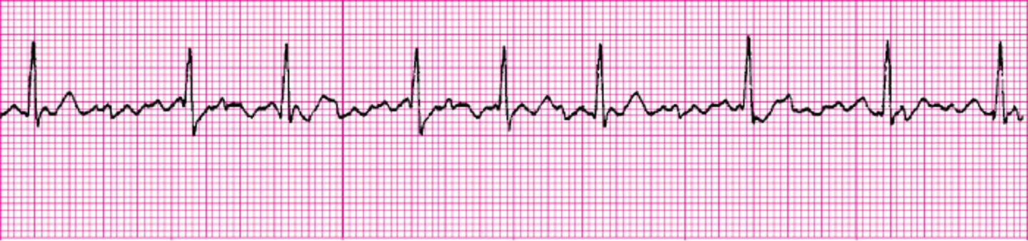 <p>What ECG is this? </p>