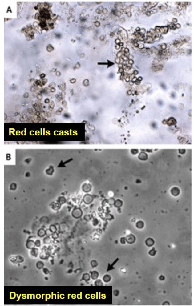 <p>                          <span style="color: red;">glomerulair</span> vs extra-glom</p><p>kleur → <span style="color: red;">rood/roest (cola)</span> — rood/roze</p><p>protein → <span style="color: red;">mogelijk > 500 mg/dag</span> — afwezig of < 500 mg/dag</p><p>stolsels → <span style="color: red;">afwezig</span> — mog aanwezig</p><p>RBC casts/cilinders →<span style="color: red;"> mog aanwezig </span>— afwezig </p><p>RBC morfologie → <span style="color: red;">dysmorfie</span> — normaal </p><p><em>acanthocyten = Mickey Mouse cellen → glomerulaire bloeding </em></p><p></p>