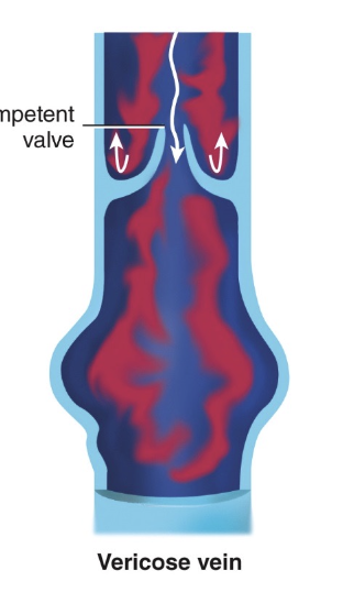 <p>formed when venous valves become weak or damaged (looks twisted)</p>