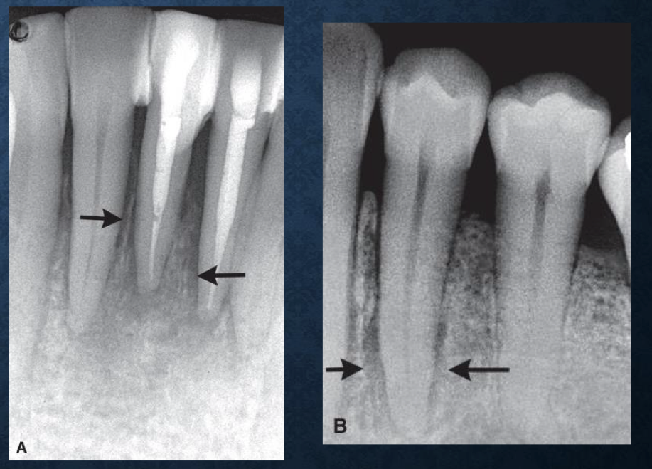 <p>malignancy, quickly grows throughout PDL space</p>