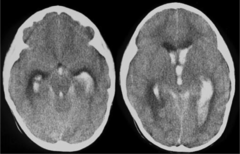 <p>bleeding that occurs from vessels along the ventricles; the bleeding in this case would be directed into the ventricles</p>