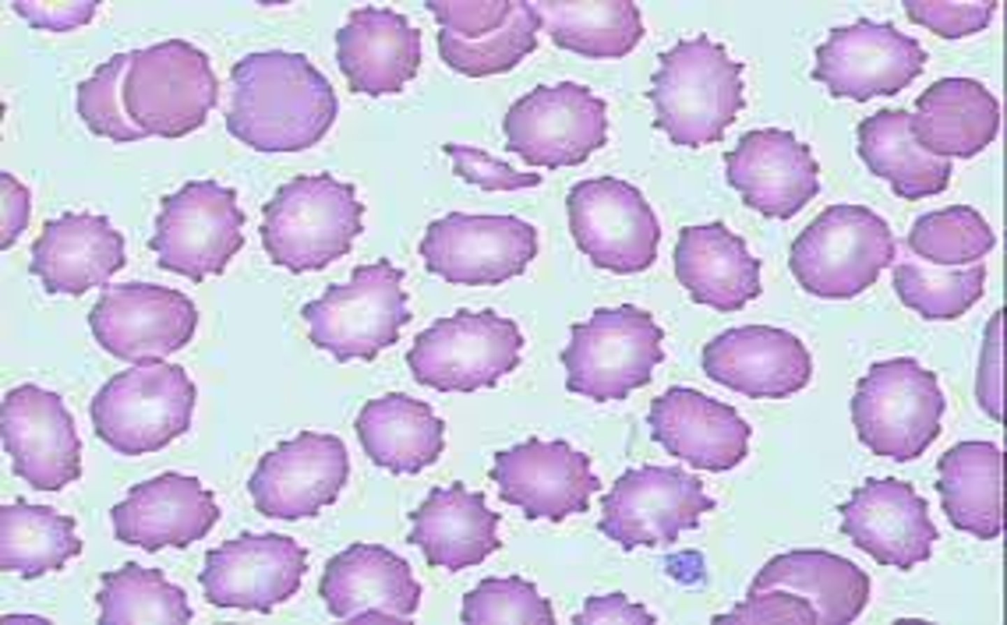 <p>Crenated RBC</p>