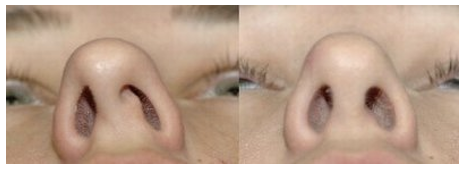 <p>Identify the pathology in the image on the left:</p>