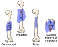 <p>-Comminuted</p><p>-Compression</p><p>-Impacted</p><p>-Stress</p><p>-Avulsion</p>