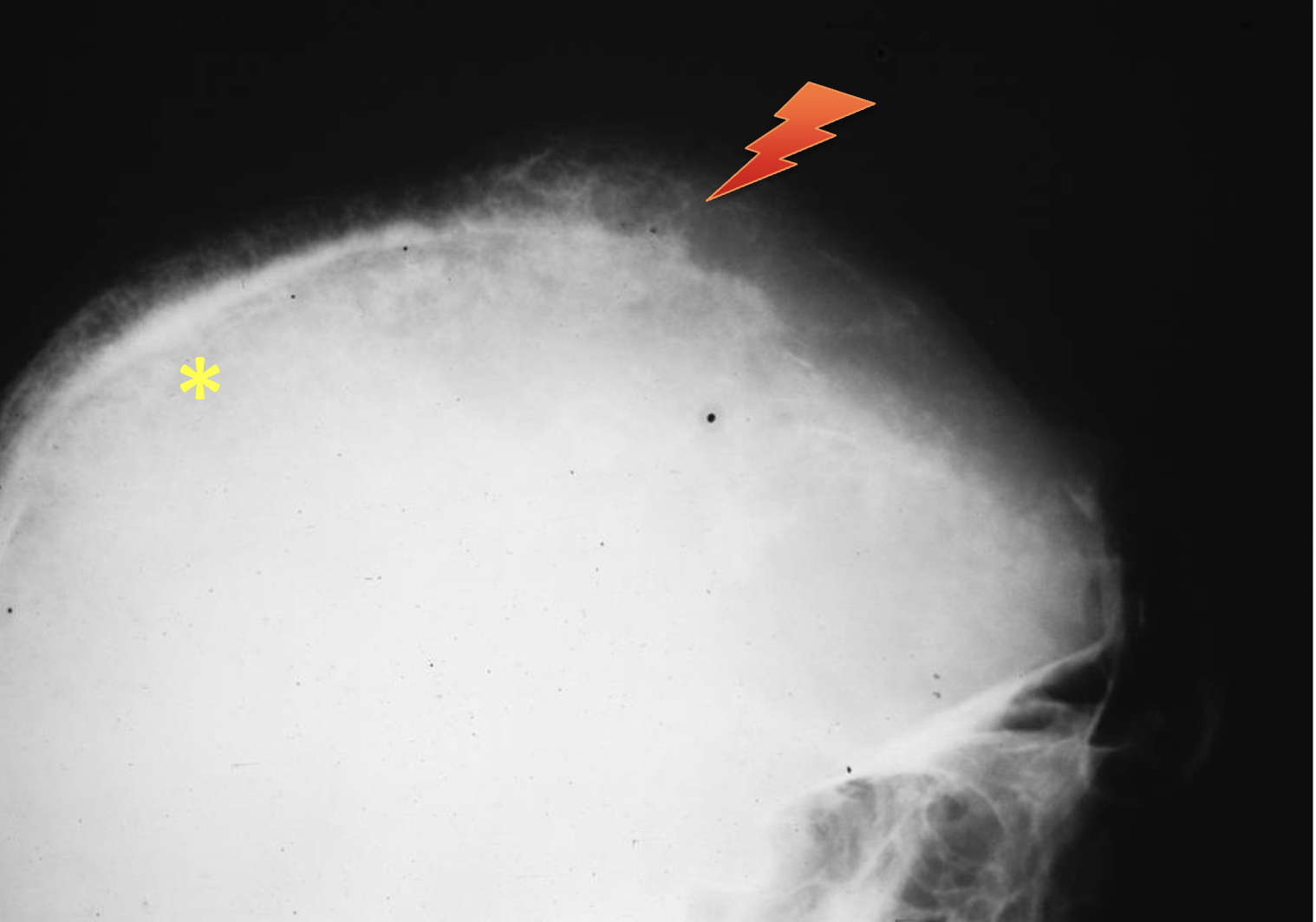 <p>What tumour like disorder is this?</p>