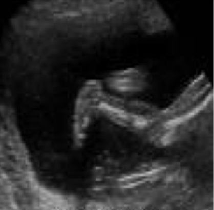 <ul><li><p>characterized by prominent heel bone and convex rounded bottom of foot</p><ul><li><p>70% bilateral; 30% unilateral</p></li></ul></li><li><p>associated with:</p><ul><li><p>chromosomal anomalies </p></li><li><p>T18</p></li></ul></li><li><p>surgical interventions needed</p></li><li><p>SONO:</p><ul><li><p>sole of foot is convex/rounded</p></li></ul></li></ul><p></p>