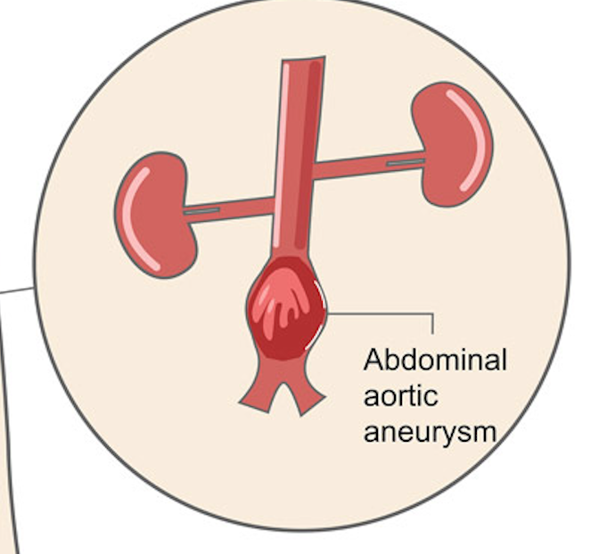 <p><strong>ABDOMINAL AORTIC ANEURYSM</strong></p>