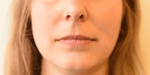 <p>Lip Stretcher</p>