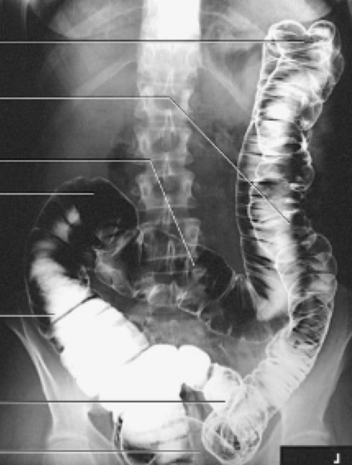 <p>Entire large bowel</p>