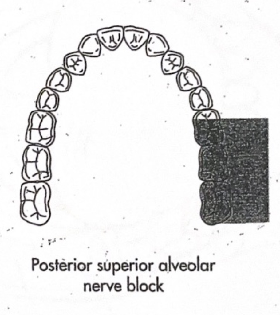 <p>mucobuccal fold above maxillary 2nd molar</p>