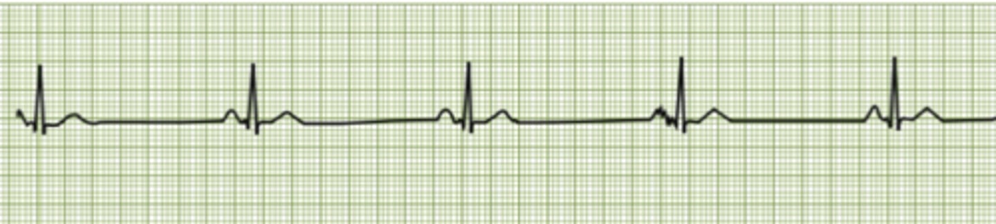 <p>QRS complexes are farther apart otherwise looks normal</p>