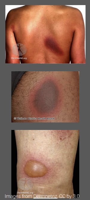 <p>Characterized by the formation of an erythematous or pigmented patch (round or oval shape) </p><p>Early lesions are sharply demarcated erythematous macules </p><p>Lesion may progress to become edematous, forming a plaque, which may evolve to become a bulla (blister) and then an erosion </p><p>Lesions are commonly solitary, however, there may be multiple lesions with random distribution </p><p>May become scaly and cause post-inflammatory hyperpigmentation </p><p>Patients do not generally report systemic symptoms (unless bullous form - rare)</p>