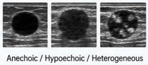 <p>Which echogenicity is benign/malignant</p>