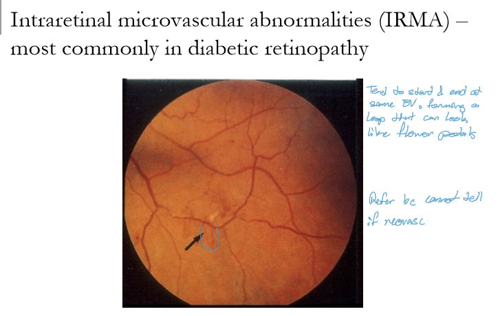 <p>IRMA are abnormal, dilated intraretinal vessels that form as shunts across areas of retinal capillary non‑perfusion.<br>They are most commonly seen in diabetic retinopathy.</p>