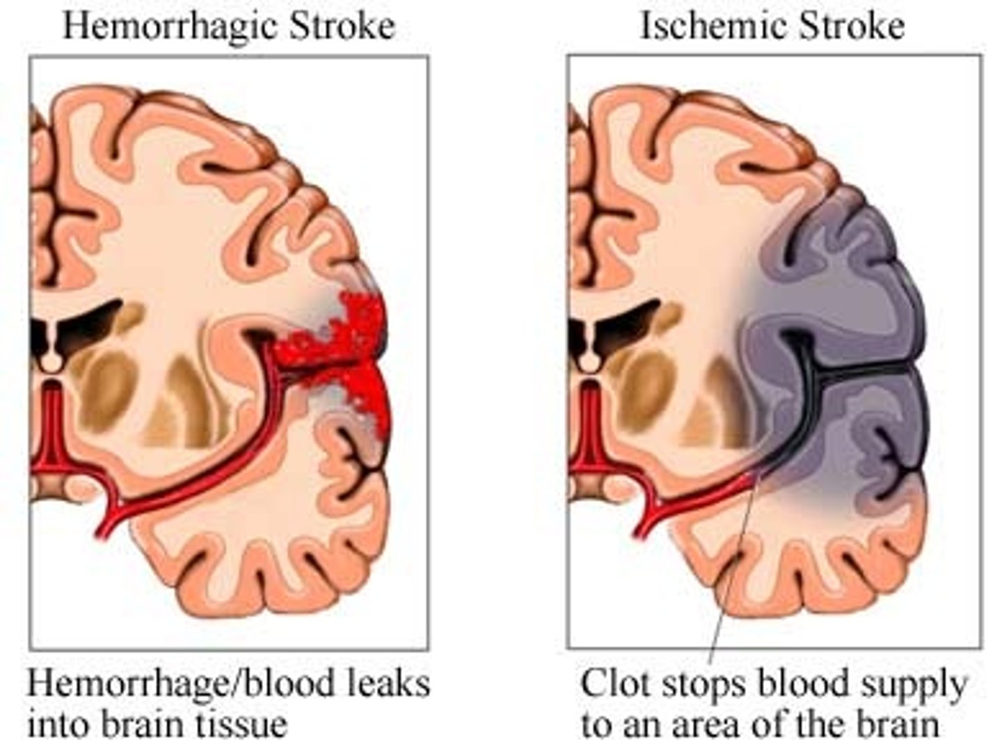 <p>a type of stroke that occurs as a result of bleeding inside the brain. accounts for 13% of all strokes. happens to people experiencing stress or excerption. highest risk are people with hypertension and a sudden severe headache.</p>
