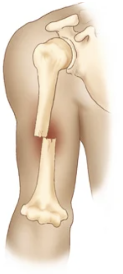 <p>bone fragments are separated and not aligned. </p>