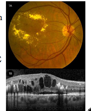 <p><strong>Macular edema</strong></p><ul><li><p>Occurs at any stage of DMR</p></li><li><p>Exudates</p><ul><li><p>Circular ring</p></li><li><p>Signal presence of DME</p></li></ul></li></ul><p></p><p></p>