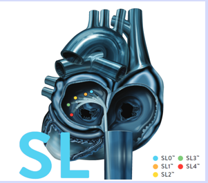 <p>SL (left sided)</p>