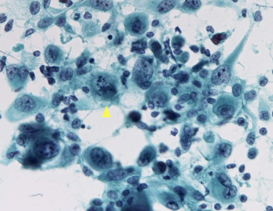 <p>1) Diagnostic cytologique bethesda</p><p>2) Diagnostic histologique</p>