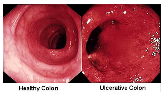 <ul><li><p><span style="background-color: transparent;">the mucosa becomes hyperemic (a lot of blood flow)</span></p><ul><li><p><span style="background-color: transparent;">may be the reason why a lot of patients may have blood in their stool</span></p></li><li><p><span style="background-color: transparent;">it gets very edematous, red, &amp; irritated&nbsp;</span></p></li></ul></li></ul><p></p>