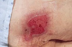 <p>Involve epidermis and may involve dermis. Shallow moist wound bed. No tissue necrosis. No slough</p>
