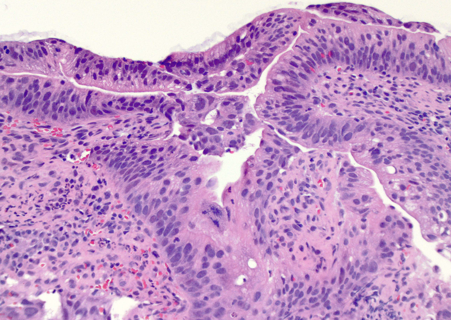 <p>diagnosis, esophageal tumor</p>