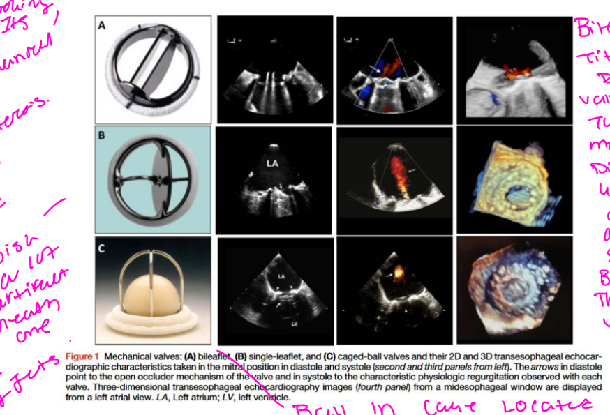 <p>• Given its durability, some of these valves continue to function</p><p>satisfactorily and may be encountered in clinical practice.</p>