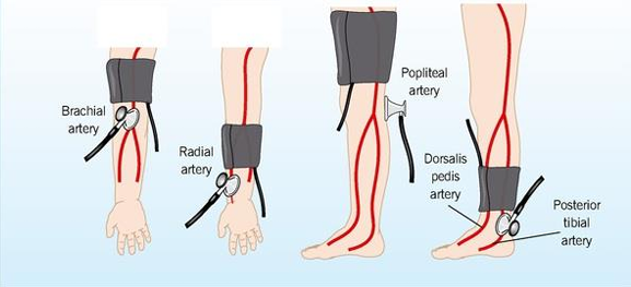 <ul><li><p>Choose different BP site from any contraindications of arms</p></li><li><p>Brachial Artery</p></li><li><p>Radial Artery</p></li><li><p>Popliteal Artery</p></li><li><p>Dorsalis Pedis Artery </p></li><li><p>Posterior Tibial Artery</p></li></ul><p></p>