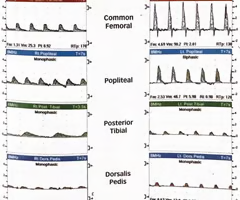 <p><span>What do these common femoral artery waveforms most likely represent?<br><br>A. Acute occlusion of the aorta<br><br>B. The waveforms are within normal limits and exclude proximal disease bilaterally<br><br>C. Believe the patient may have inflow disease in the right lower extremity<br><br>D. The waveforms are consistent with a distal embolism bilaterally<br><br>E. Believe the patient has Buerger's disease</span></p><p></p>