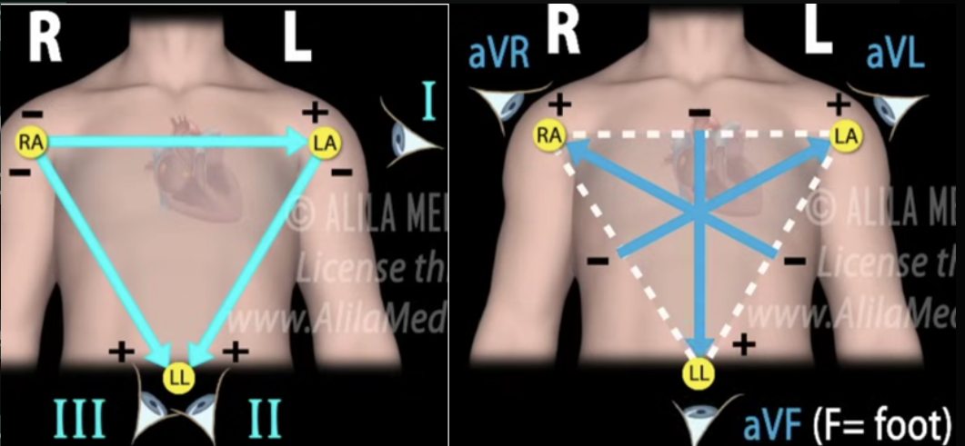 <p>A <strong>lead is not a wire</strong>, but a <strong>view of the heart’s electrical signal</strong> (looking from positive to negative) created by comparing voltage between two electrodes.</p><ul><li><p><strong>Limb leads (I, II, III):</strong> Measure heart activity in the <strong>frontal plane </strong>using arms and legs. BIPOLAR LEADS</p><ul><li><p>Lead I: Right arm → Left arm</p></li><li><p>Lead II: Right arm → Left leg</p></li><li><p>Lead III: Left arm → Left leg</p></li></ul></li><li><p><strong>Augmented leads (aVR, aVL, aVF):</strong> Provide additional <strong>frontal-plane</strong> views. UNIPOLAR LEADS</p><ul><li><p>aVR: Right arm perspective</p></li><li><p>aVL: Left arm perspective</p></li><li><p>aVF: Foot (inferior) perspective</p></li></ul></li><li><p><strong>Chest leads (V1–V6):</strong> Measure activity across the chest in the <strong>horizontal </strong>plane.</p><ul><li><p>V1–V2: Right heart / septum</p></li><li><p>V3–V4: Anterior wall</p></li><li><p>V5–V6: Lateral wall</p></li></ul></li></ul><p></p>