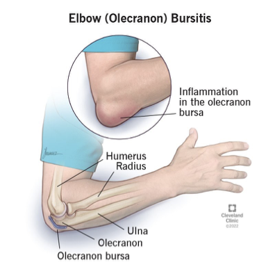 <p>Sacs containing <strong>synovial fluid</strong> that help <strong>minimize friction</strong> in areas subject to stress; <strong>absorbs excessive forces</strong> that are applied to the elbow joint (e.g., higher-impact daily forces, trauma)</p><ul><li><p>Seven bursa surround the elbow</p></li><li><p>Olecranon bursa is the largest</p></li><li><p>Olecranon bursitis is common from blunt force (“hitting”) the elbow</p></li></ul><p></p>