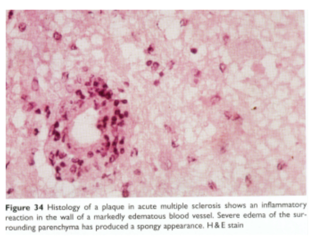 <ul><li><p>Rond blanc : vaisseau, autour de celui-ci il y a un amas de cellules mononucléées, beaucoup de macrophages et de lymphocytes</p></li><li><p>À l’intérieur de cette plaque c’est ballonisé, c’est démyélinisée</p><ul><li><p>on va surtout d’abord des macrophages qui sont bourrés de myéline puis on retrouve des lymphocytes T et des lymphocytes B</p></li></ul></li></ul><p></p><p></p>
