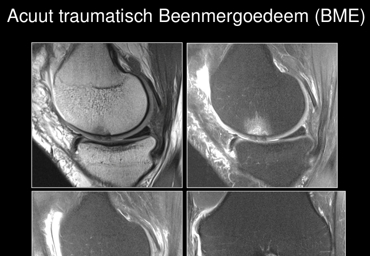 <p>T2 vetsupressie: wit vlekkerig in been (zwart/donkergrijs)</p>