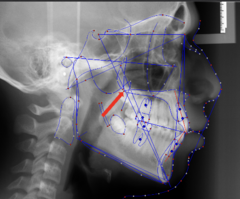 <p>which anatomical landmark:</p><p>- The tip of the posterior nasal spine</p><p>- The most posterior point on the hard palate</p>