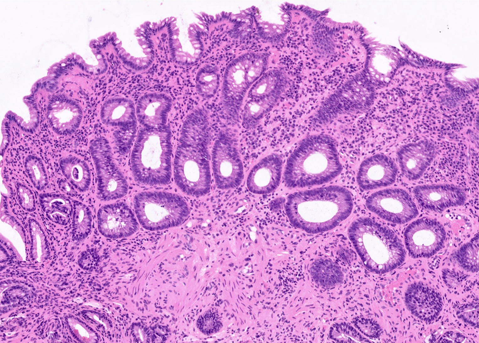<p>polype du rectum </p><p>1) diagnostic </p><p>2) entités regroupées </p><p>3) caractéristiques histologiques </p>