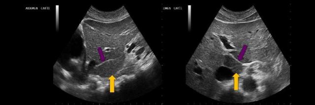 <p>The yellow arrow on the image represents which of the following structures?</p>