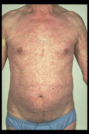 <p><span>–Morbilliform exanthem</span></p><p><span>macular rash </span></p>
