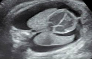 <p>aka: hydrothorax </p><ul><li><p>accumulation of fluid in pleural space </p></li><li><p>manifestation of fetal hydrops, ascites and edema </p></li></ul><p></p>