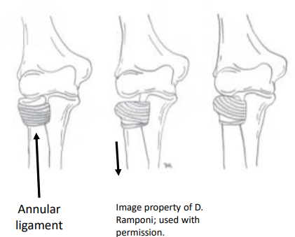 <p>Nursemaid’s elbow</p>