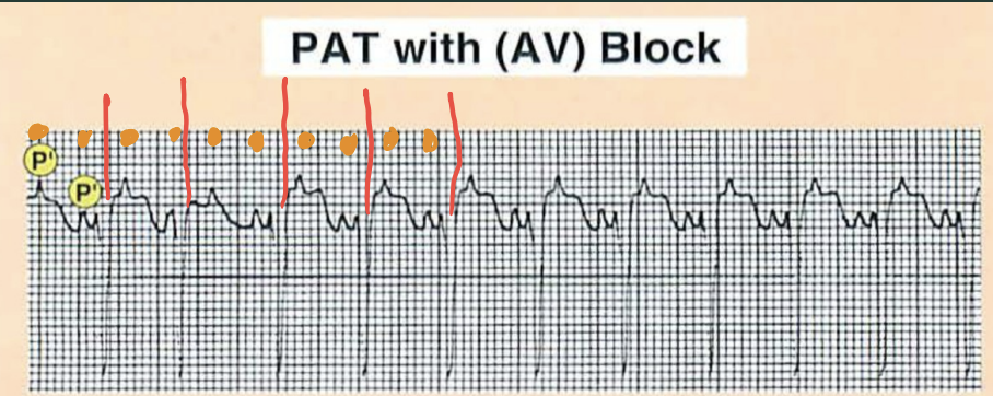 <p>What is different about a PAT with block?</p>