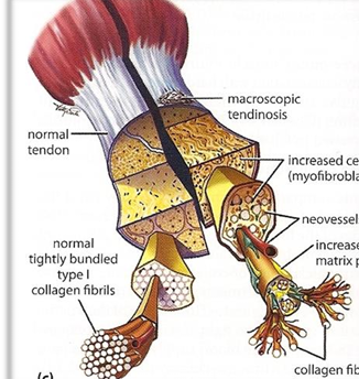 <ul><li><p>Stage 1 : NO inflammation associated with pathologic tissue alterations </p></li><li><p>Stage 2: Alterations characterized by disrupted collagen architecture Fibroblastic and hypervascular response, No inflammatory cells </p></li><li><p>Stage 3: Tendinosis with tissue structural failure (e.g., microtearing) </p></li><li><p>Stage 4: Continued failure with fibrosis/calcification</p></li></ul><p></p>