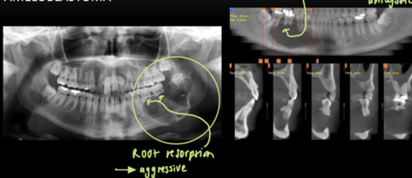<p>- Root resorption</p><p>- Expansive</p><p>- Multilocular</p>