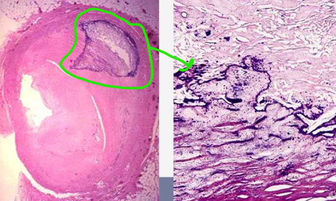 <ul><li><p>kaupiasi pažeistame audinyje (nekrozė, uždegimas, randas)</p></li><li><p>nepriklauso nuo Ca konc. kraujyje</p></li></ul><p></p>
