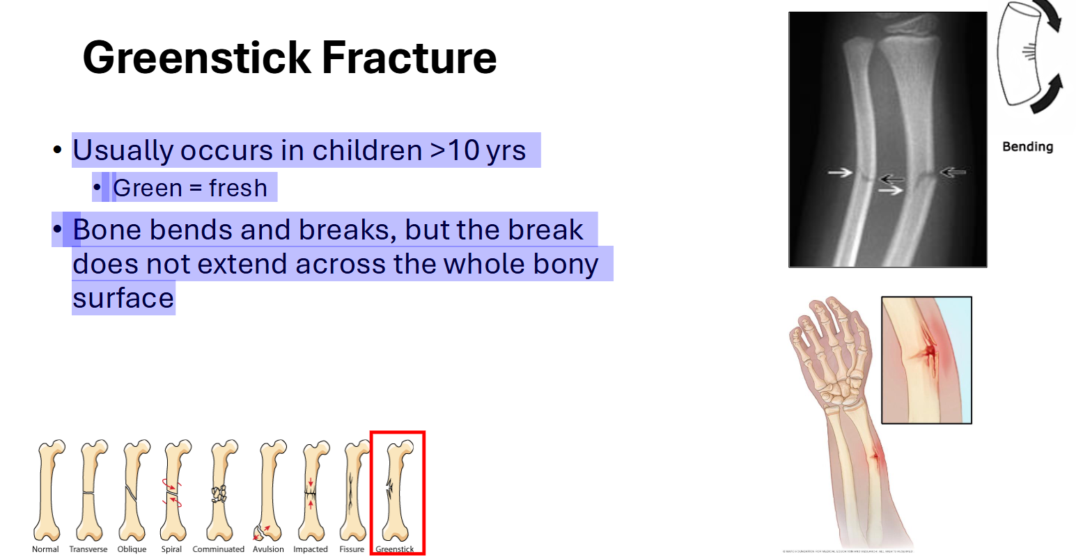 <p>Greenstick Fracture</p>