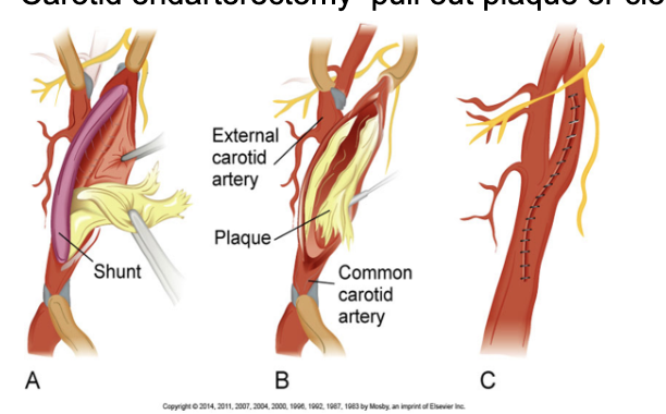 <ul><li><p><span style="background-color: transparent;">In the common carotid artery or internal carotid artery, Endarterectomy is the removal of material on the inside of the artery.</span></p></li></ul><p></p>