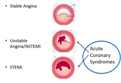 <p>acute coronary syndrome</p>