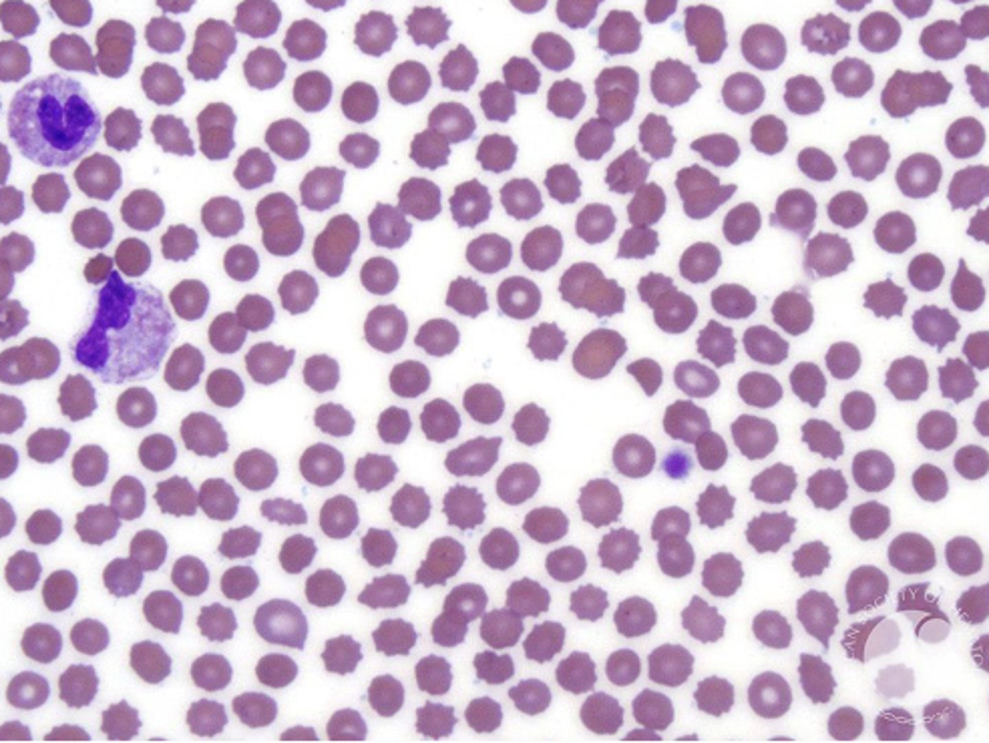 <p>Abnormal RBC membrane seen in metabolic disease like uremia or liver disease (can also be a lab error)</p>