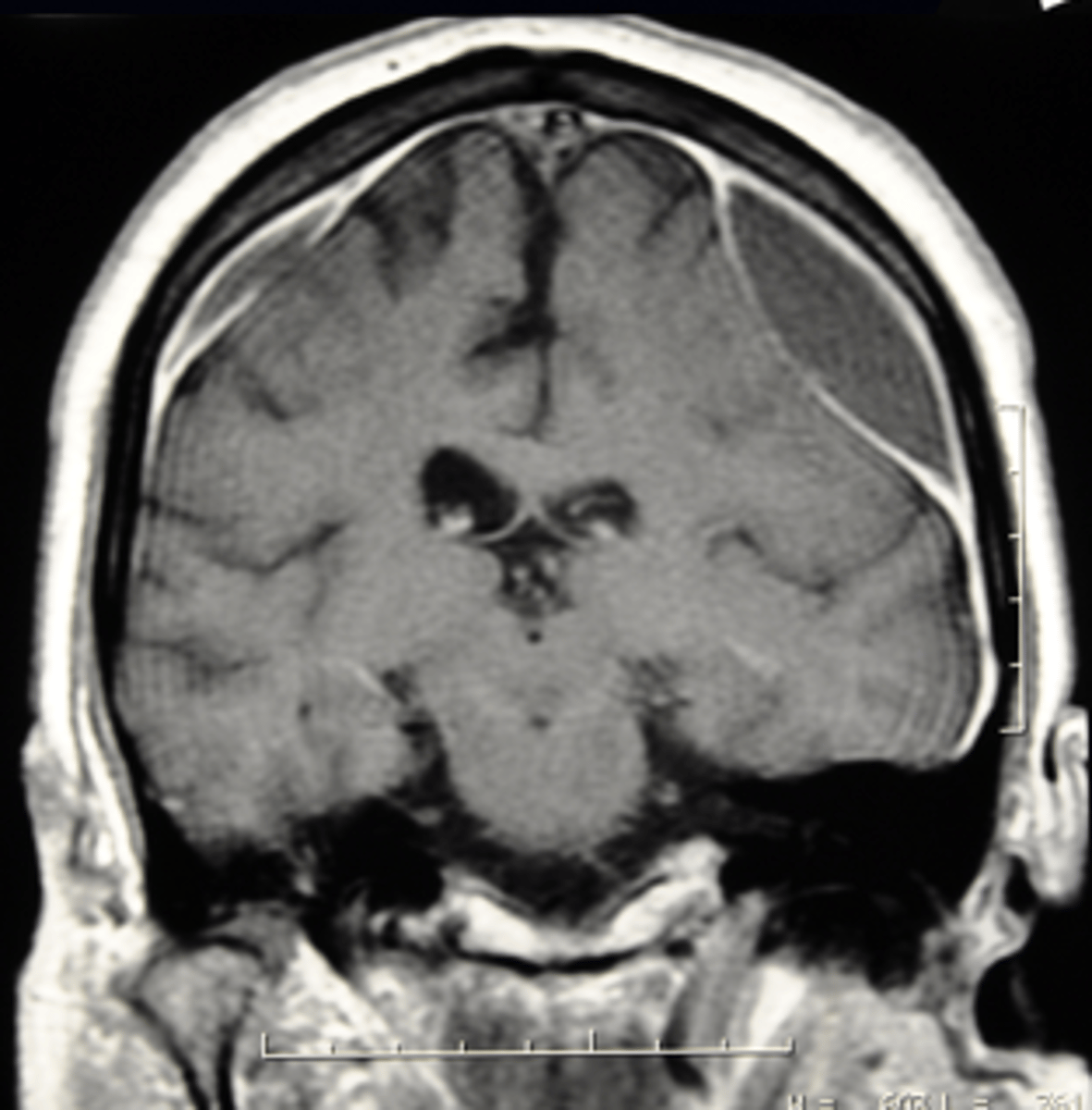 <p>B. Subdural hematoma</p>