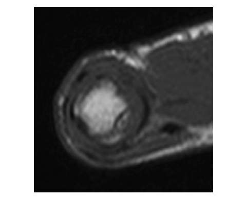<p><span style="line-height: inherit; font-size: inherit;"><strong>Gamekeeper thumb</strong> <strong>is an injury to the ulnar collateral ligament </strong>of the thumb at the level of the first metacarpophalangeal joint. This injury can occur from skiing or falling on to an outstretched hand. </span></p><p><span style="line-height: inherit; font-size: inherit;"><strong>Appearance on MRI:</strong></span></p><ul><li><p><span style="font-family: inherit; line-height: inherit; font-size: inherit;">•</span></p><p>May show <strong>avulsion fracture </strong>at the attachment site of the <strong>ulnar collateral ligament</strong> (one-third of cases).</p></li><li><p><span style="font-family: inherit; line-height: inherit; font-size: inherit;">•</span></p><p>Shows tear of the ulnar collateral ligament as a <strong>thin, low-signal ligament</strong> or discontinuity of the ligament with<strong> hemorrhage and edema</strong> surrounding the torn ends of the ligament.</p></li></ul><p></p>